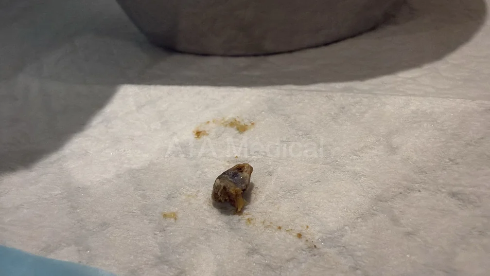 Pieces of ear wax removed during a professional ear wax removal procedure